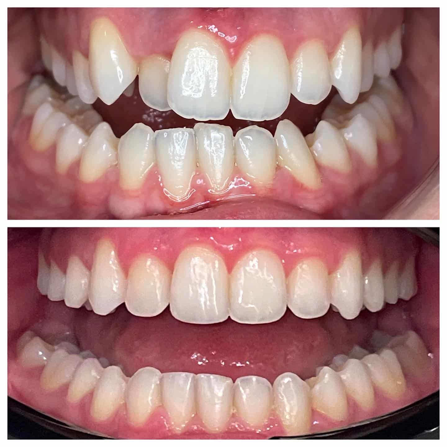 Before and after dental treatment showing corrected tooth alignment and whitening at Babin Dental.