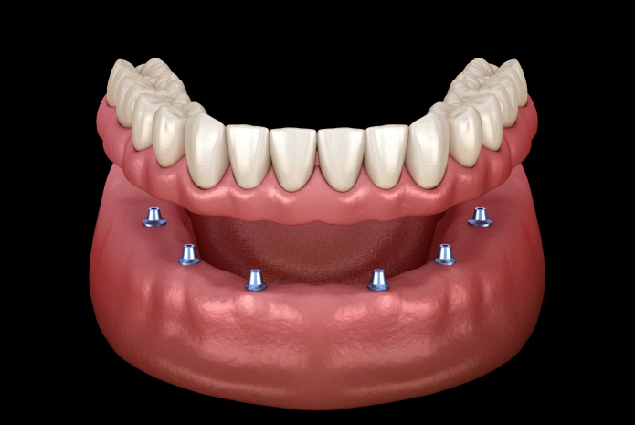 Dental implant model showing eight implants anchoring a full upper denture prosthesis.